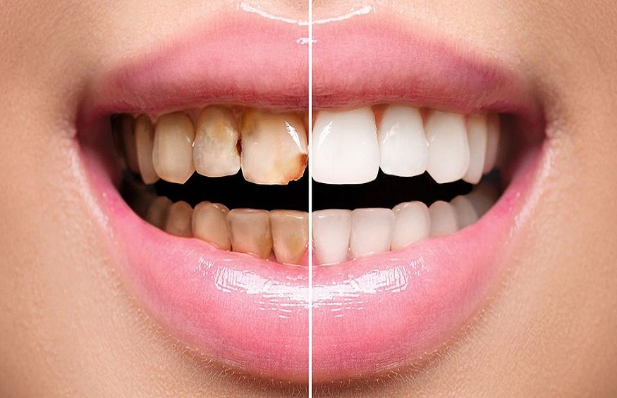 What are the advantages of opting for dental veneers?
