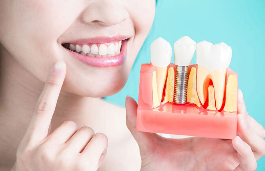 Dental Implant Recovery: What to Expect