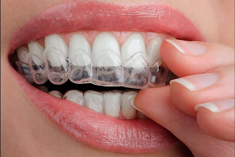Teeth Whitening Can Make You Happier & More Confident