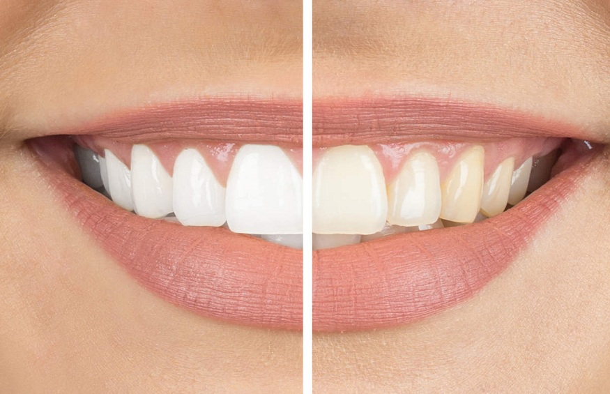 Teeth Whitening Treatment – Home Remedies