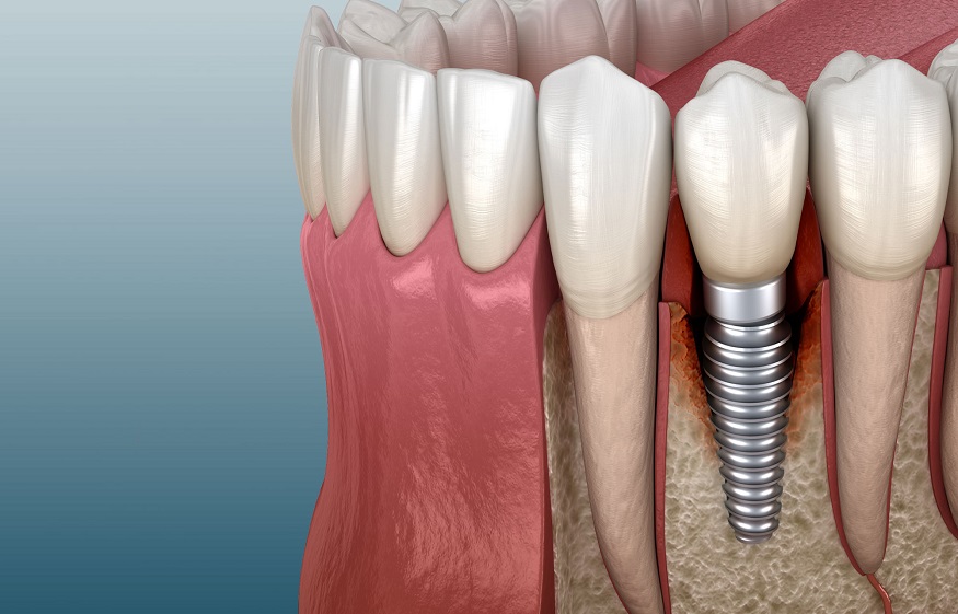 Dental Implants: What You Should Know