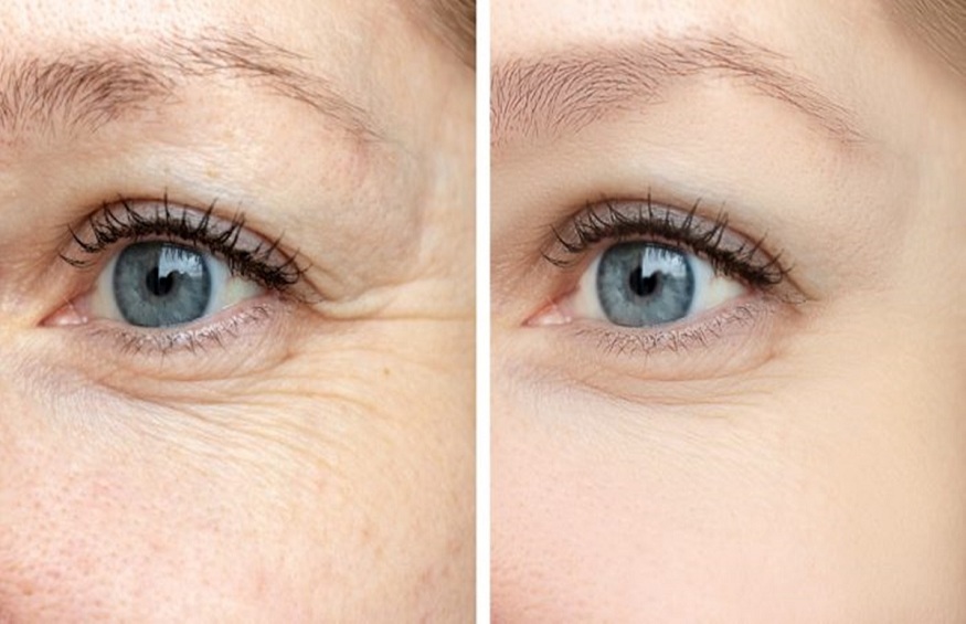 What Are the New Facial Fillers For Wrinkles, and also Do They Work?