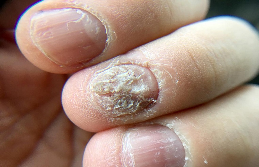 Everything you Need to Know About Nail Fungus