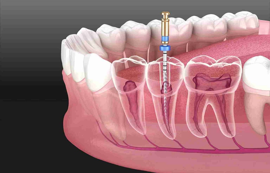 Why Root Canal Is A Tooth Saver?