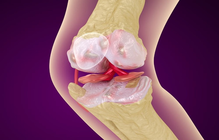 Do Leukocytes Make PRP Therapy For Knee Osteoarthritis More Effective?