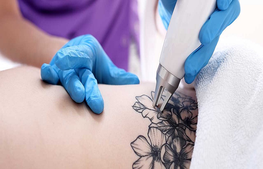 The Benefits of Tattoo Removal Services in New York