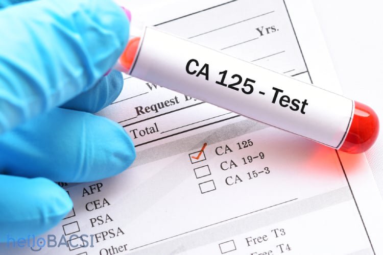 CA125 Test: A Complete Guide
