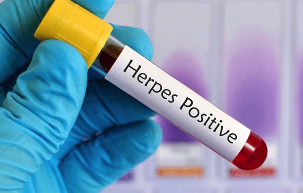 Herpes Test: Complete Guide with Other Exam