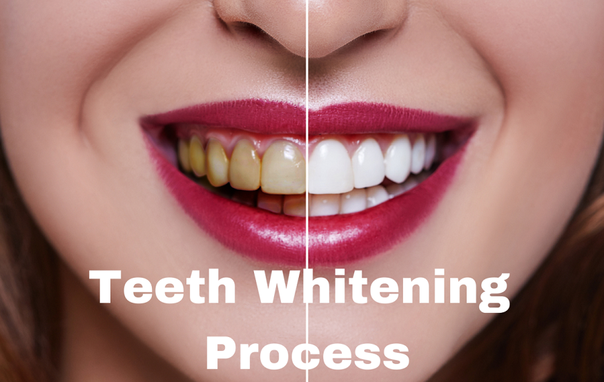 How Much Will You Pay for Teeth Whitening in the UK?