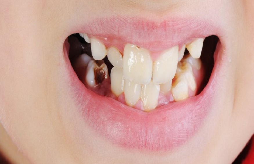 The A-Z of Tooth Enamel: Why It’s Vital and How to Protect It