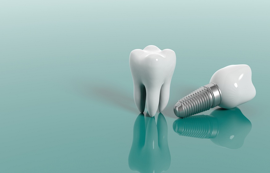 How to Take Care of Your Dental Implants: Tips for Longevity