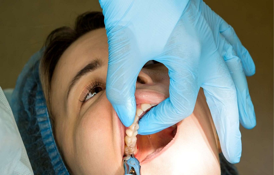 Why Choosing an Experienced Dentist Matters for Wisdom Teeth Removal