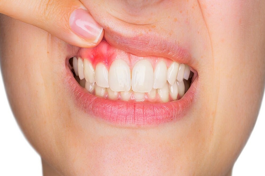 What Happens to Your Teeth and Gums When You Lose a Tooth?