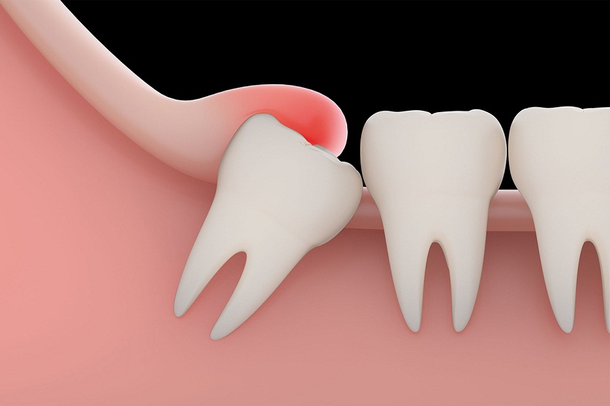 Soft Tissue Wisdom Teeth Impaction: Causes, Symptoms, and Treatment