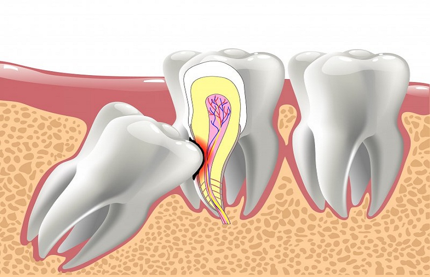 The Connection Between Wisdom Teeth and Orthodontic Issues