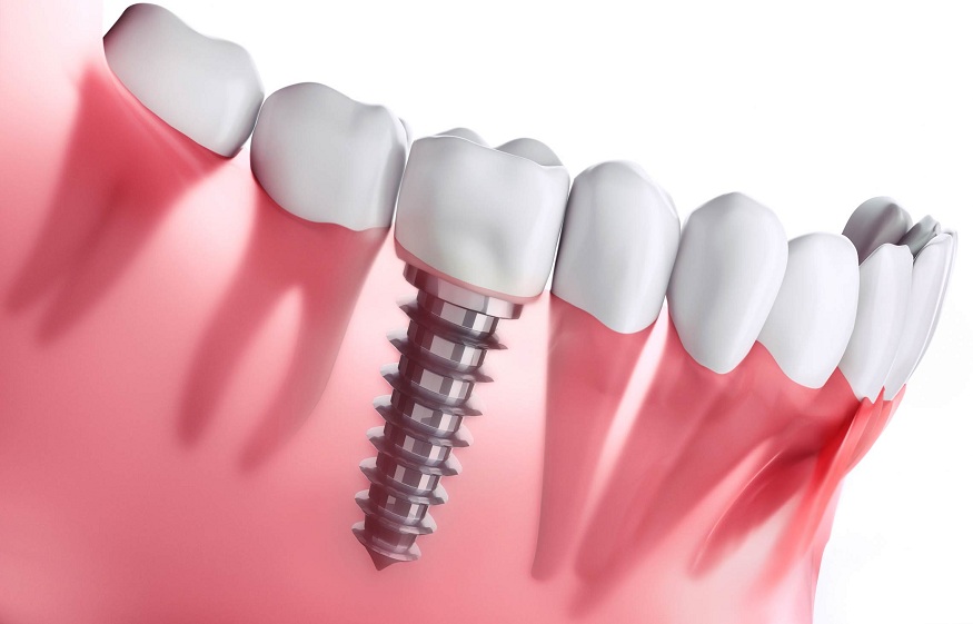 The Psychological Impact of Restoring Your Smile with Implants