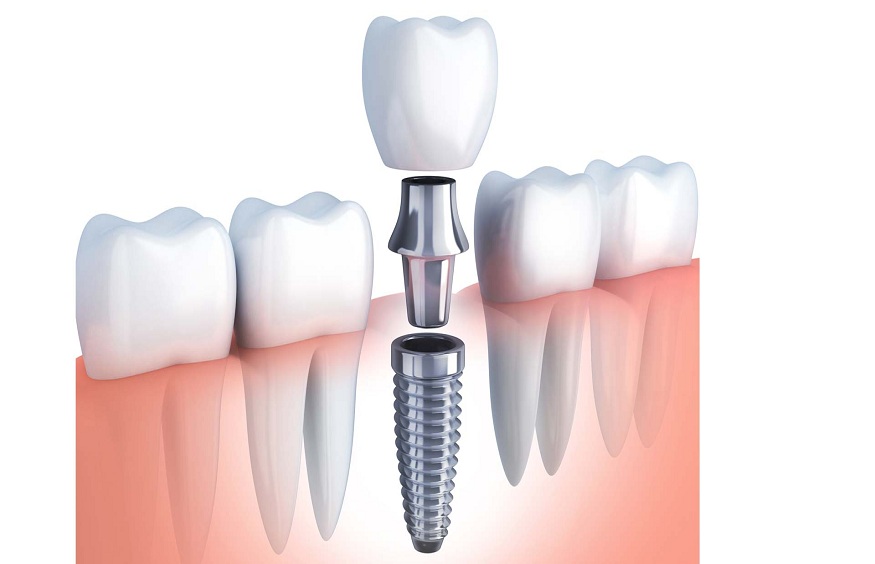 How to Know When It’s Time for a Dental Implant: Common Warning Signs