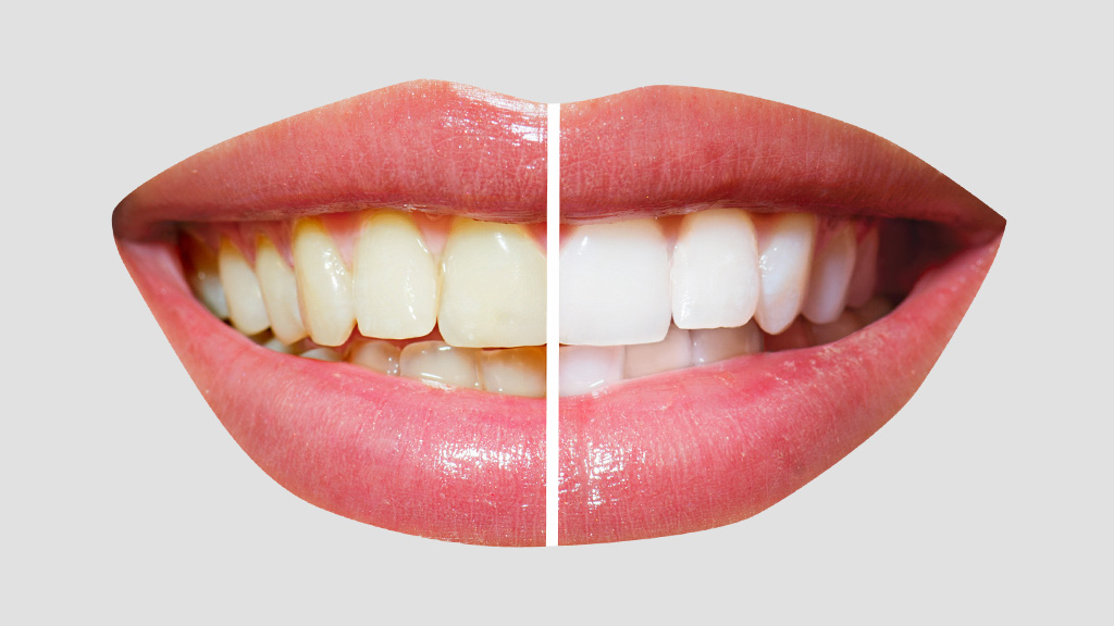 New Year, New Smile: Why Teeth Whitening Should Be Part of Your Resolutions