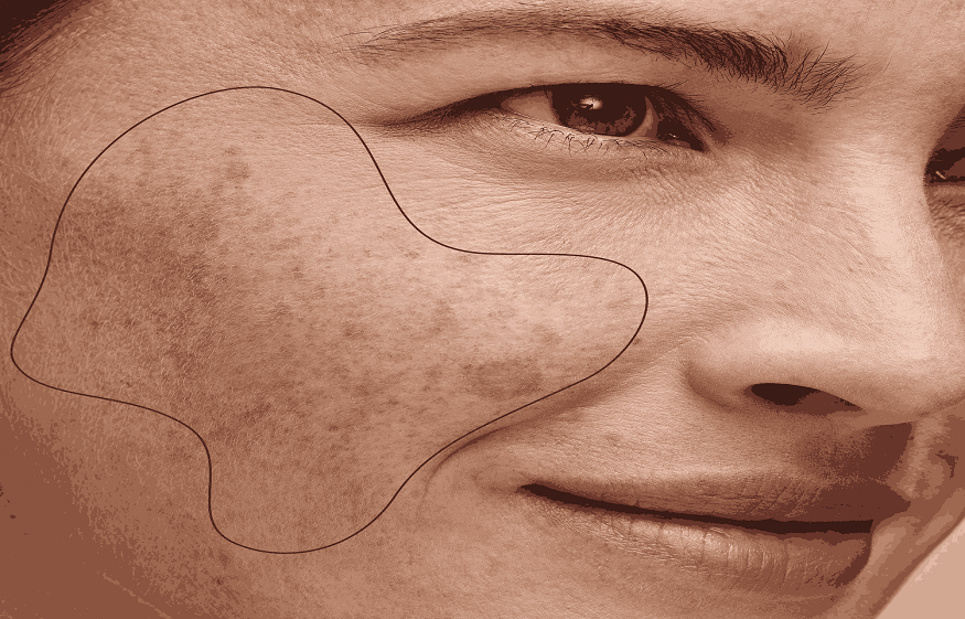Is Glycolic Acid Effective for Pigmentation Treatment?