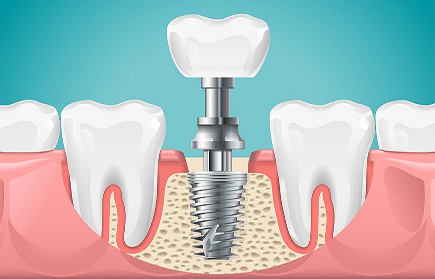 Understanding Why Dental Implants Are the Closest Thing to Natural Teeth