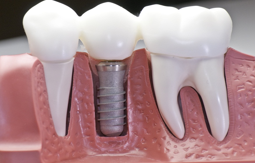 Financing Dental Implants: Payment Plans, Insurance, and Affordable Options