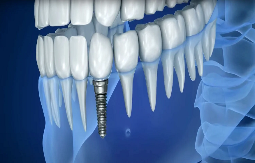 How Much Is a Single Tooth Implant in Sydney? Average Prices Revealed